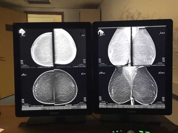 Τεχνητή νοημοσύνη: Η χρήση της στη μαστογραφία πιο αποτελεσματική στη διάγνωση καρκίνου από δύο ακτινολόγους